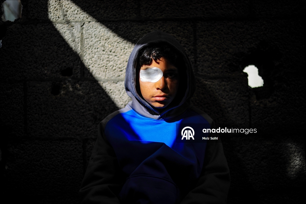 Палестинский ребенок, потерявший один глаз в результате атаки Израиля, мечтает после лечения снова играть в футбол со сверстниками