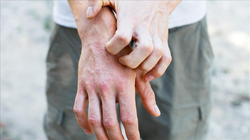 Atopik Dermatit hastalığı son yıllarda hızla artıyor